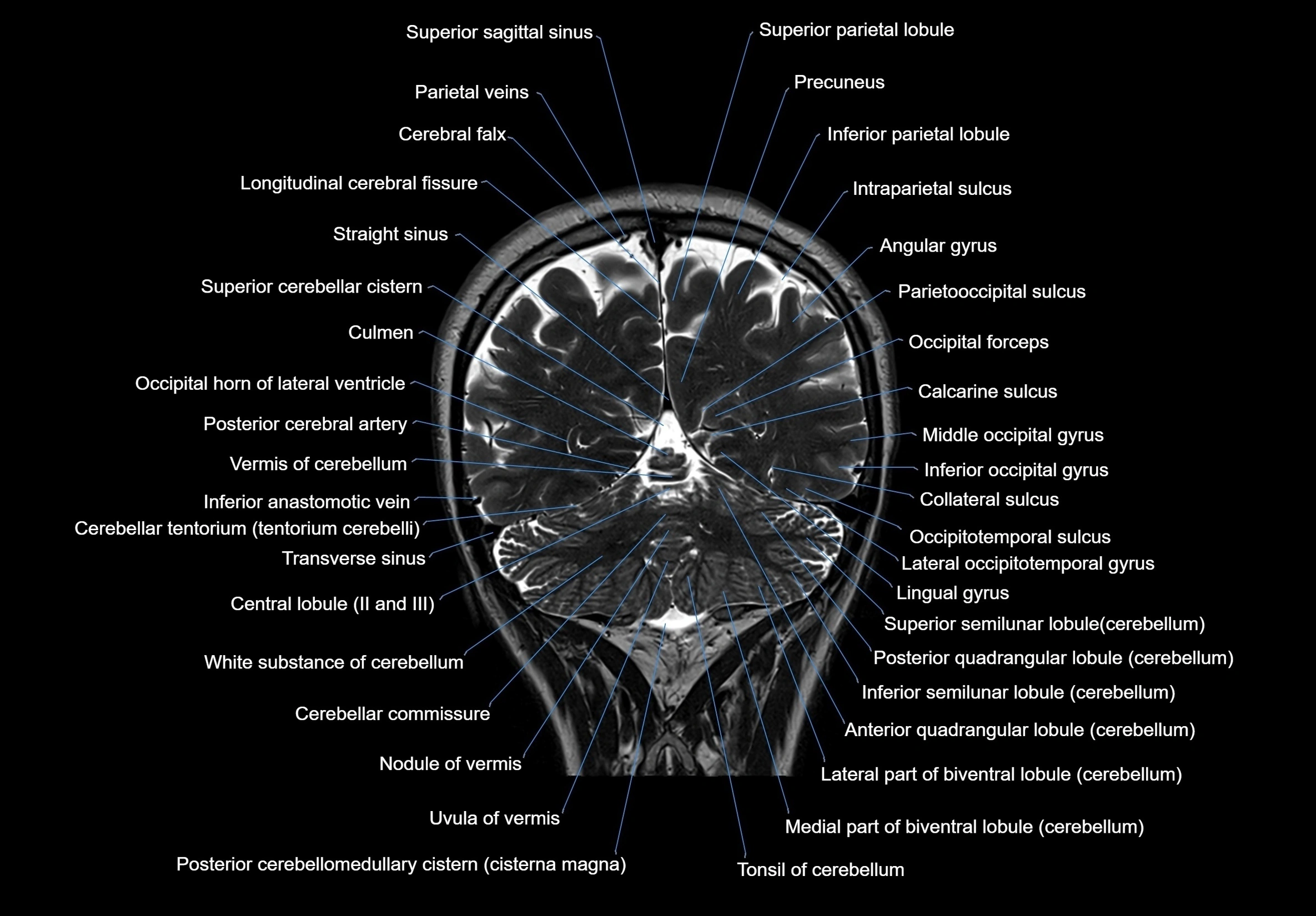 MRI Brain coronal cross sectional labelled anatomy 3T image  -img-00001-00056.webp
